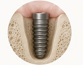 Illustration de la pose d’un implant dentaire associée à une greffe osseuse au cours de la même intervention.