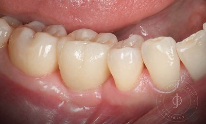 Résultat clinique après restauration d’une molaire sur implant dentaire.