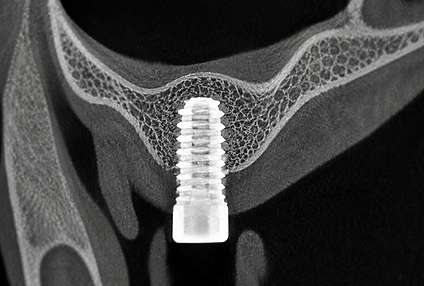 Imagerie dentaire illustrant un implant dans un volume osseux reconstruit.