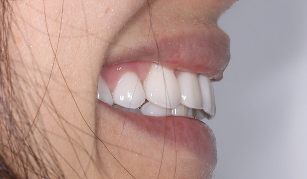 Sourire esthétique après réhabilitation par facettes dentaires