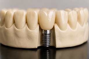 Modèle d'implant dentaire illustrant l'intérêt d'un traitement orthodontique avant une réhabilitation prothétique ou implantaire.