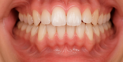 Vue rapprochée d'un chevauchement des dents illustrant un encombrement dentaire pouvant être corrigé par un traitement orthodontique.