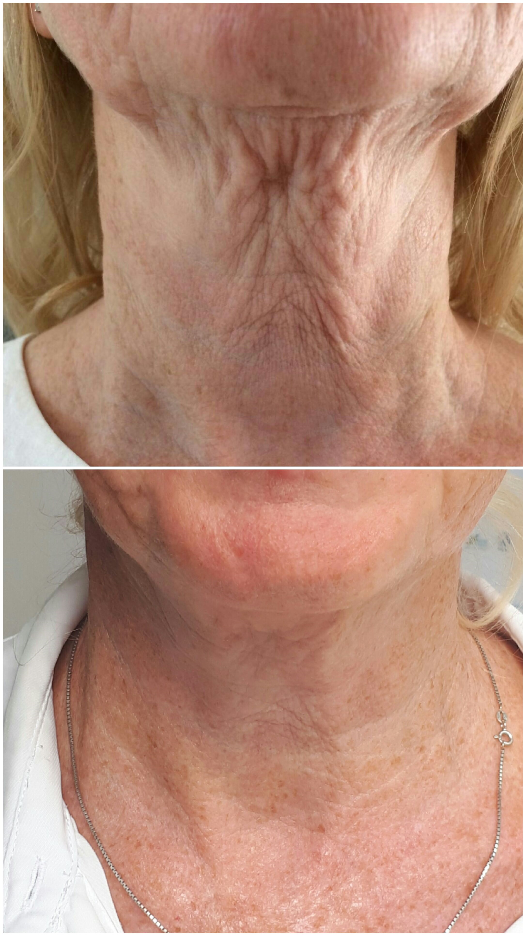 Fibrosthetics neck lift