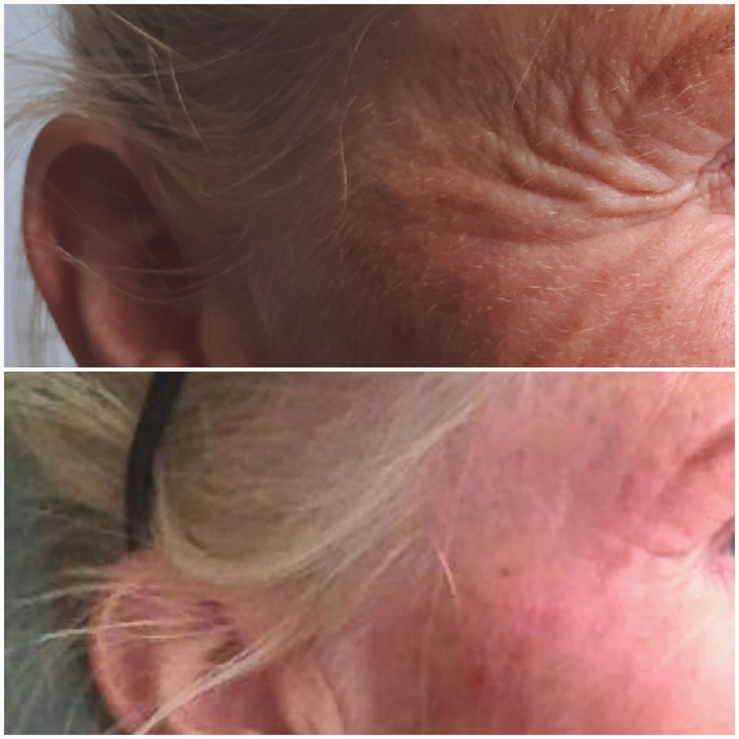 Fibrosthetics on crows feet