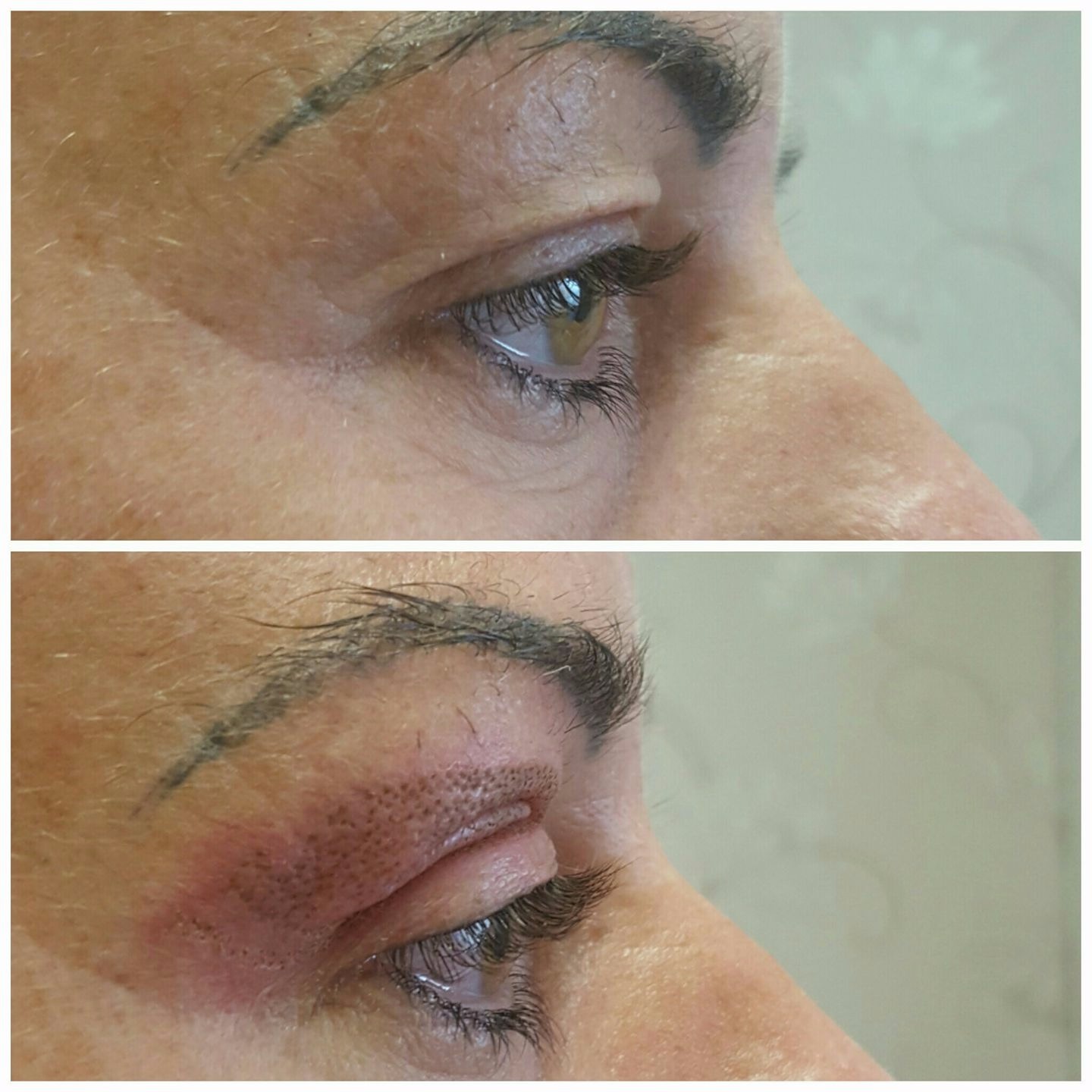 Hooded eye