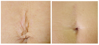 Belly button tightened