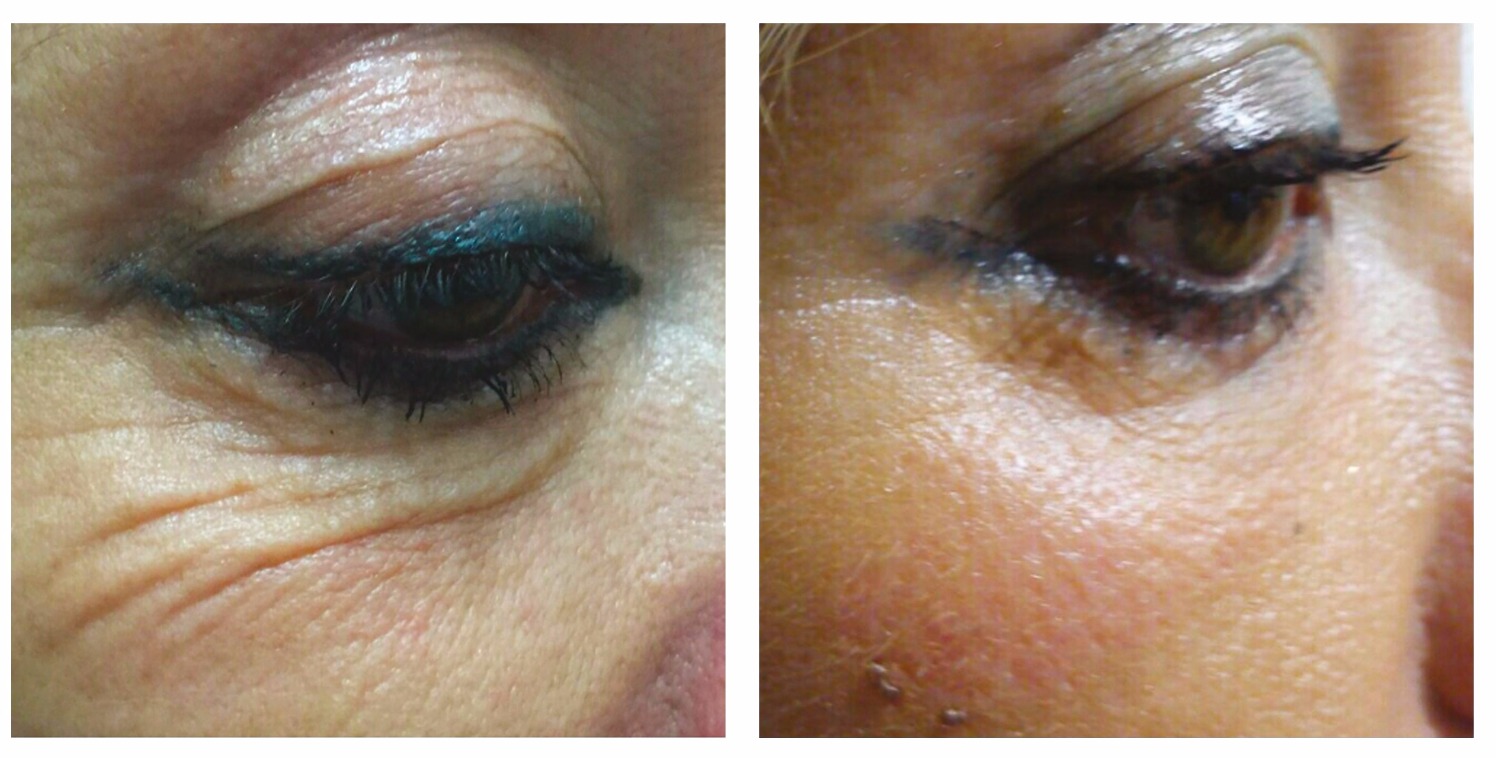 Fibrosthetics Under eye