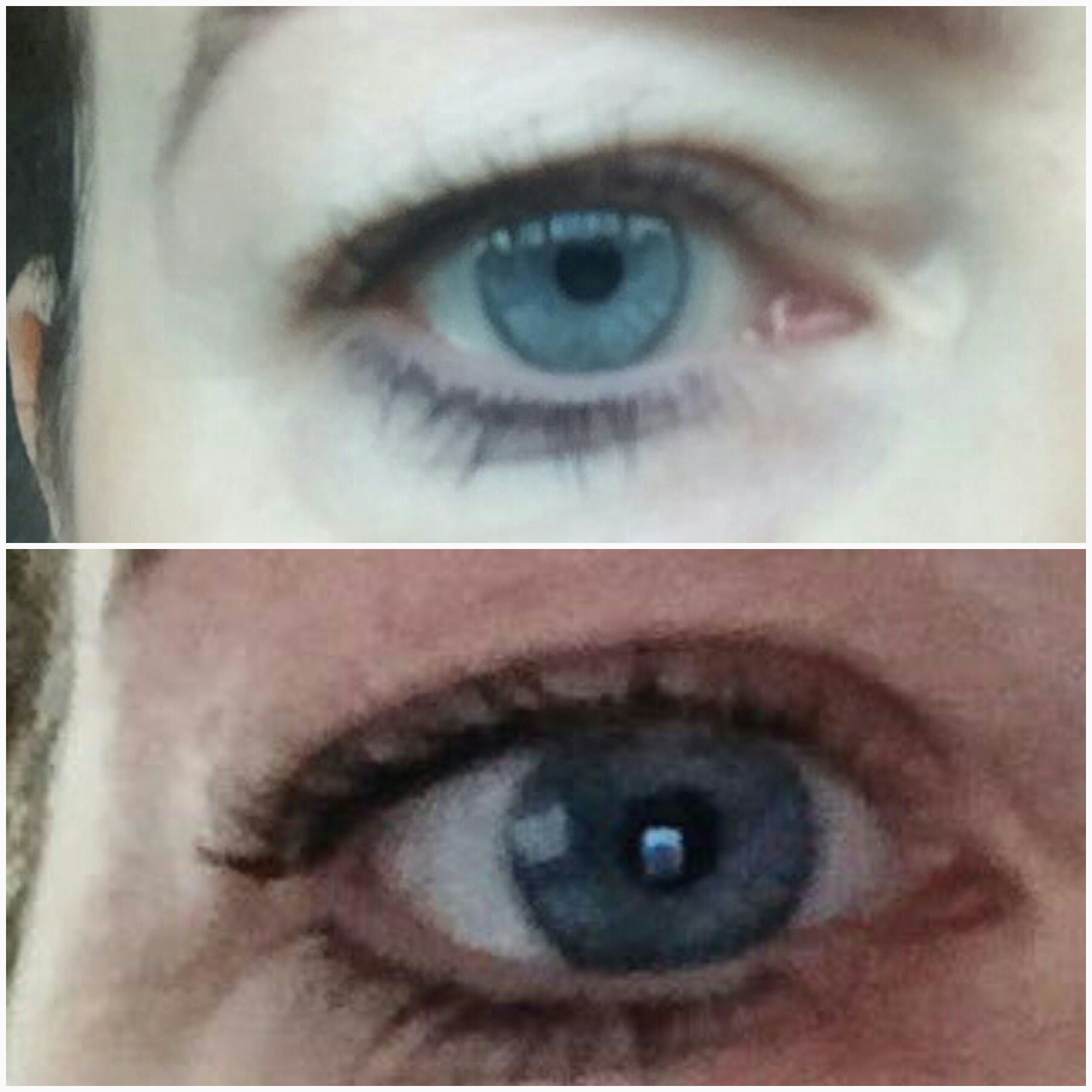 Fibrosthetics eye lift