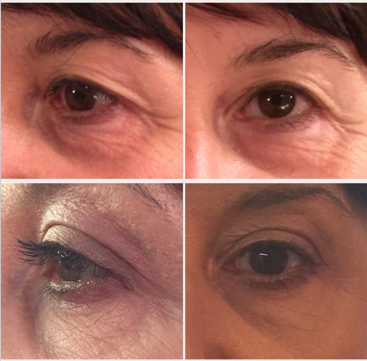 Hooded eyes