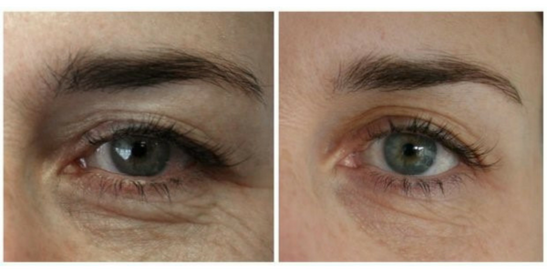 Hooded eyelids