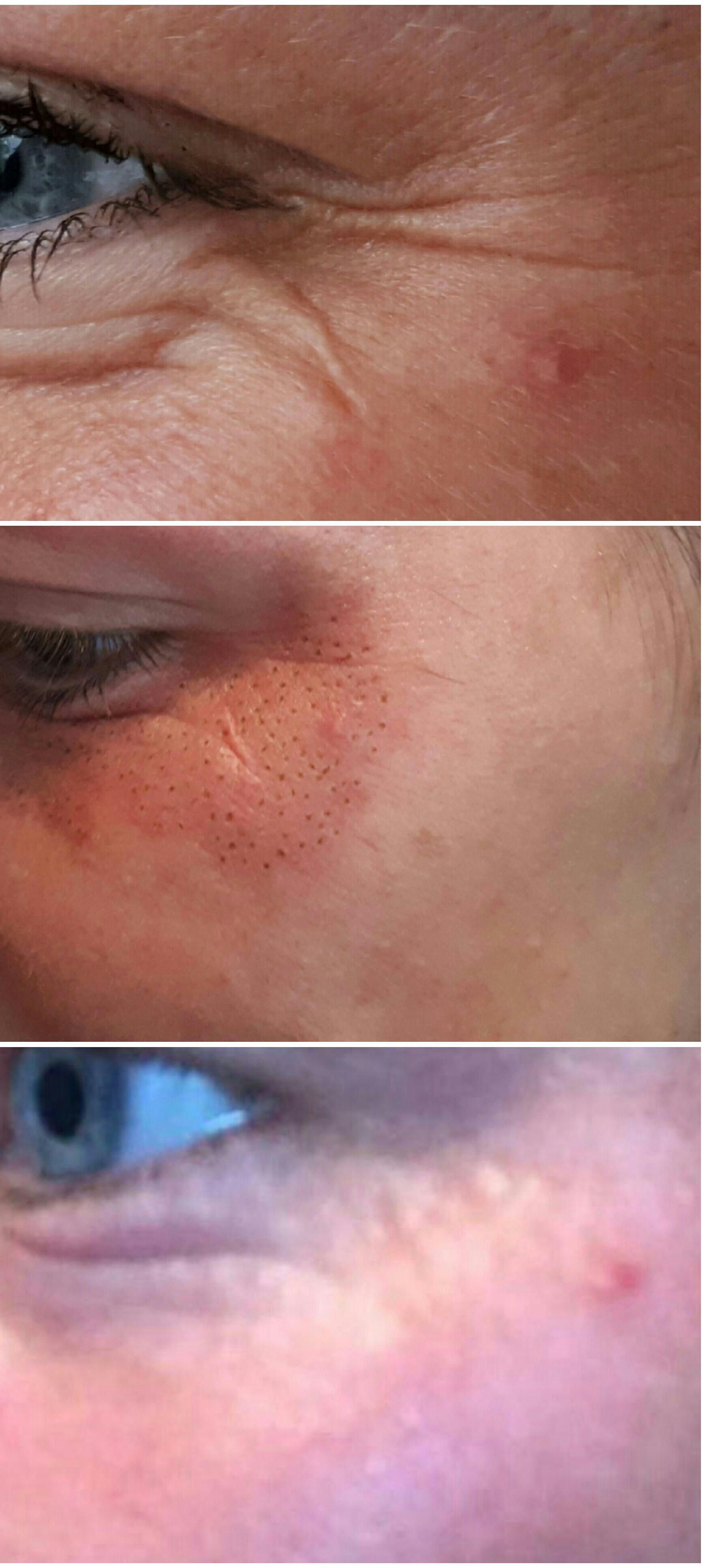 Fibrosthetics under eye
