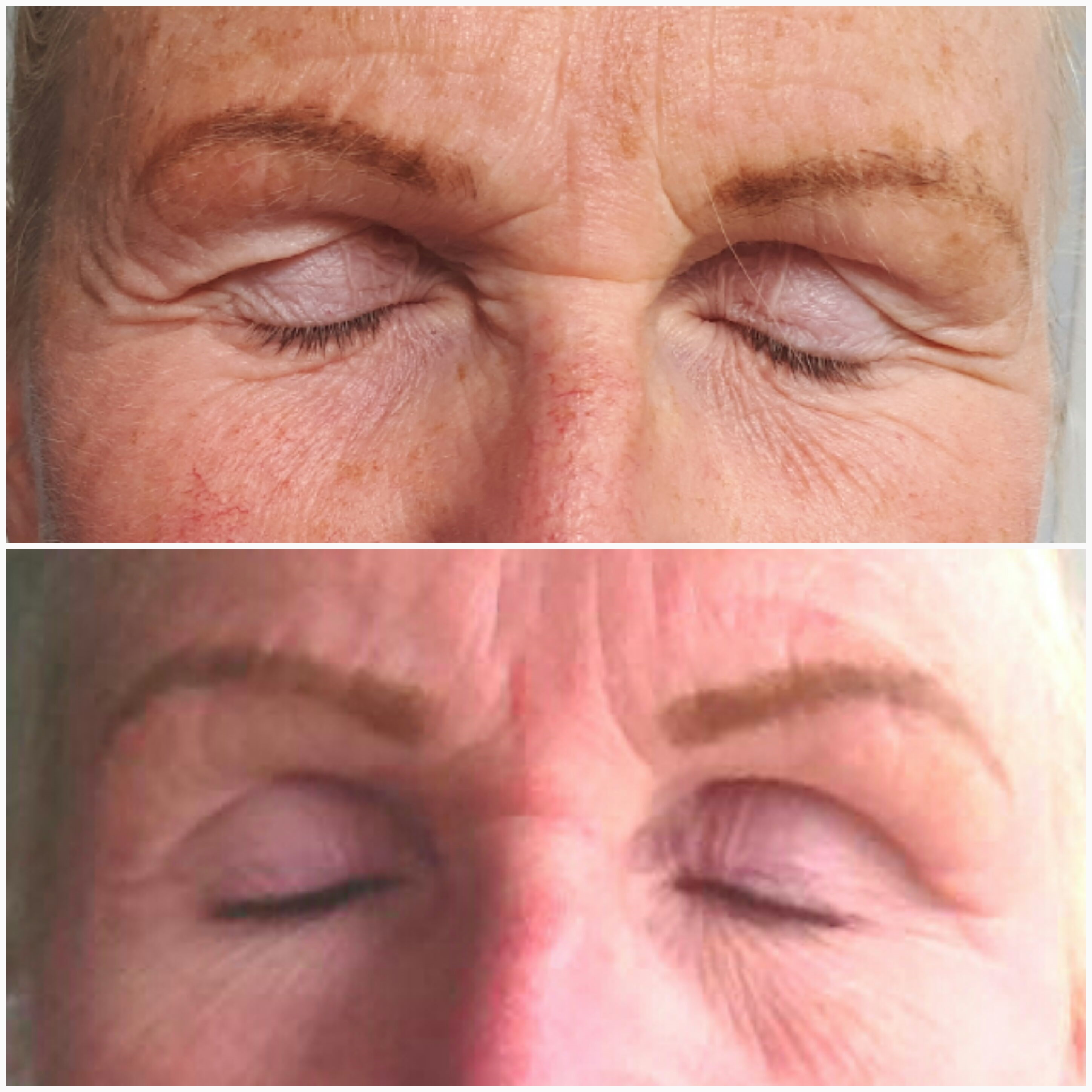 Fibrosthetics on eyelid