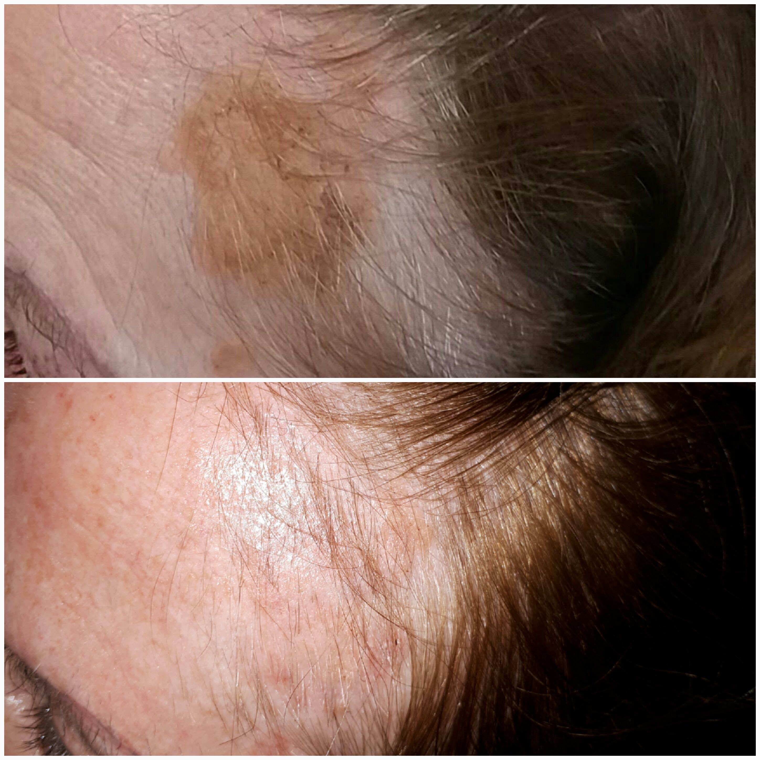 Sebborheic kerotosis