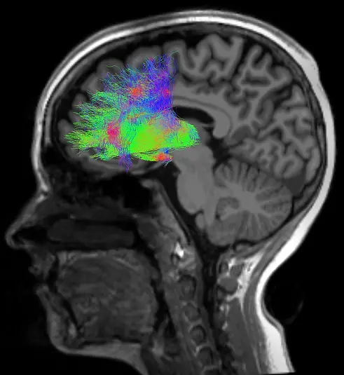 MD-PFC_tractography_MengxingLiu_TuftsUniversity.webp