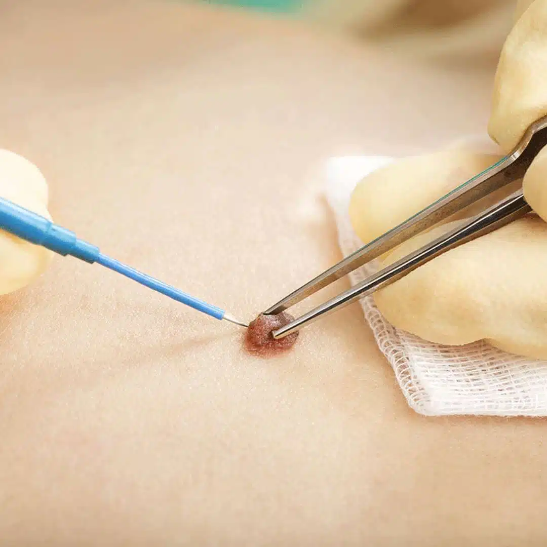 Microsuction Ear Wax Removal Irrigation Ear Syringing Lesion