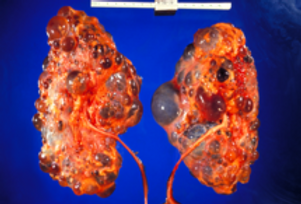 215px-Polycystic_kidneys,_gross_patholog
