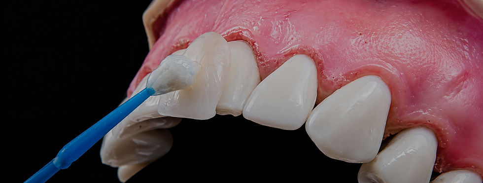 Dental veneers treatment for enhancing smile shape and appearance