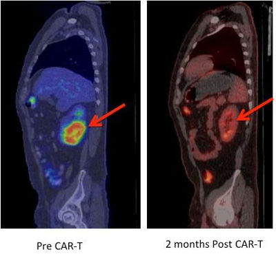 source: http://www.europeanpharmaceuticalreview.com/38923/news/industry-news/extraordinary-t-cell-therapy-results-could-change-the-face-of-cancer-treatment/