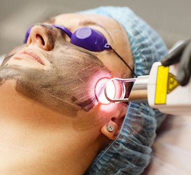 carbon facial.jpg