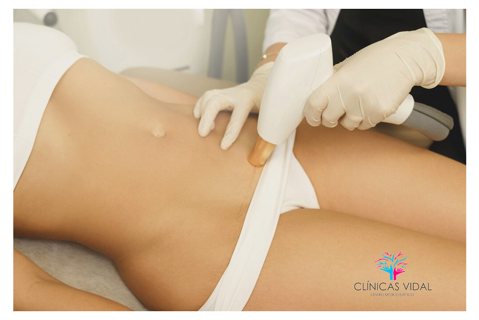 depilacion laser ingles en Alicante