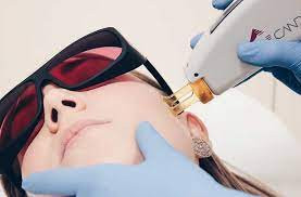 depilación-laser-facial-Alicante