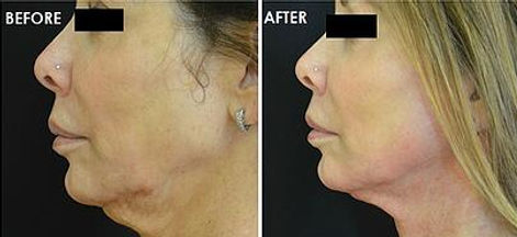 scarlet srf neck.jpg