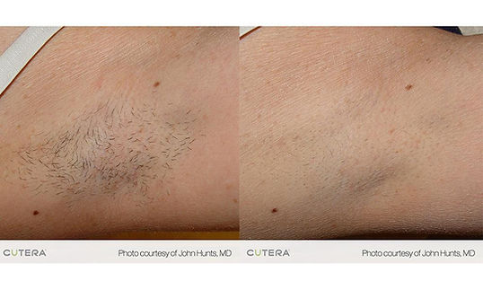 cutera hair removal.jpeg