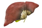 Gallbladder cancer, Cholangiocarcinoma, Surgery, Sydney