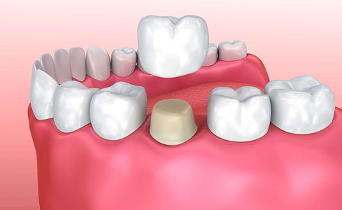 Bowie_MD_Dentist_Crown_Placement.jpeg