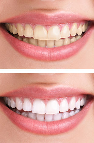 teeth-bleaching.jpg