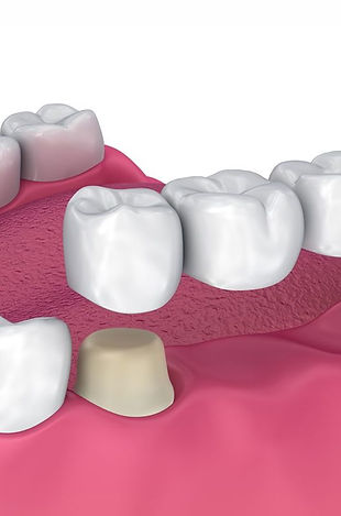 dental-bridges-1200x800.jpg