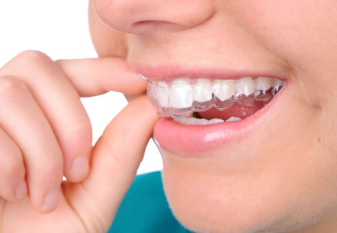 smile-aligner1.jpeg