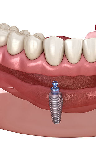 implant-supported-overdenture.jpg