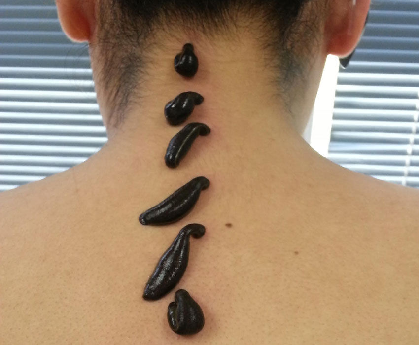 1407258547_girudoterapiya-pri-gryzhe-sheynogo-otdela