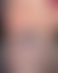 Embrace Your True Reflection: Collagen Induction Therapy with the FDA-Approved SkinPen at 360ENVY Aesthetics & Wellness