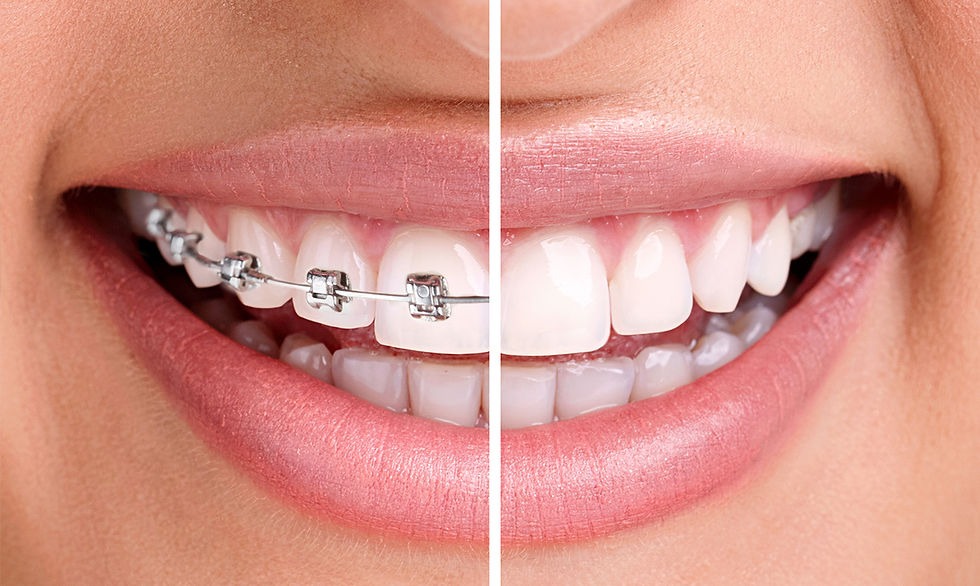 bg-banner-metal-braces-vs-clear.jpg