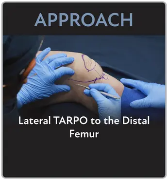 Lateral TARPO to the Distal Femur Approach Video