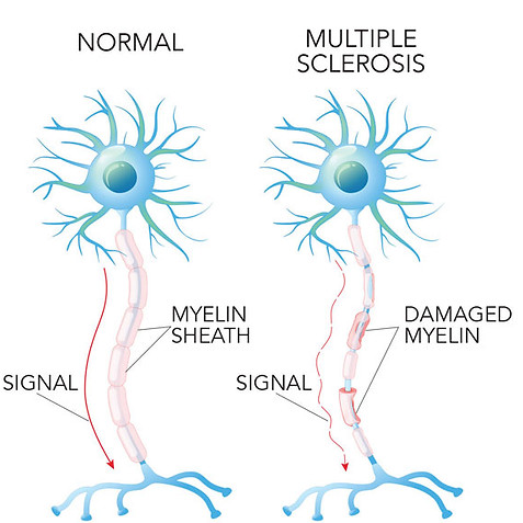 ms-nerve-cells.jpg