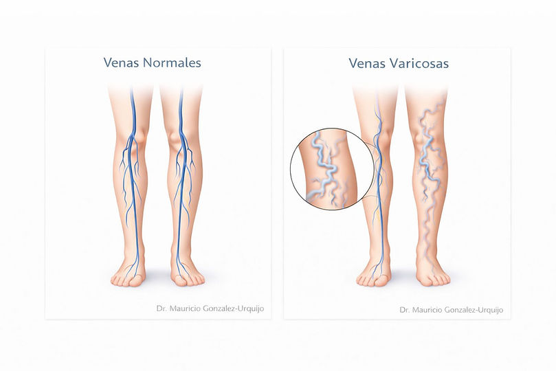Varices