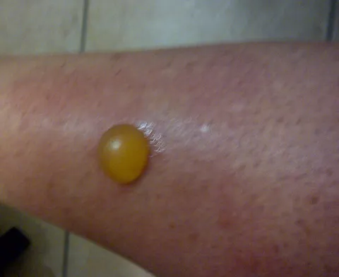 Recluse Spider Bites Spiderzrule