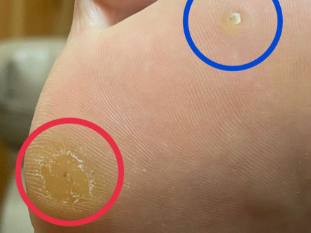 【疣贅(いぼ)】足の裏にできるいぼの原因・症状・セルフケアを前橋市のフットケアサロンが解説