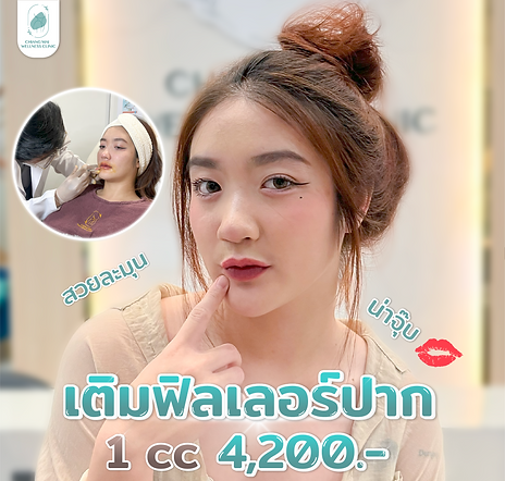 Neuramis Filler Promotion