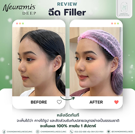 Neuramis Chin Filler