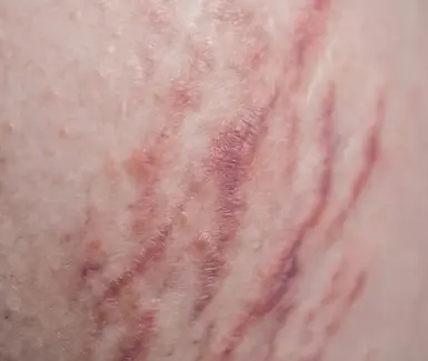 удаление растяжек в Дубае - клиника EDEN AESTHETICS.webp