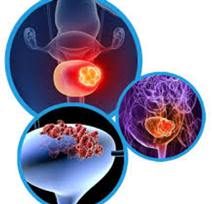 bladder cancer.jpg