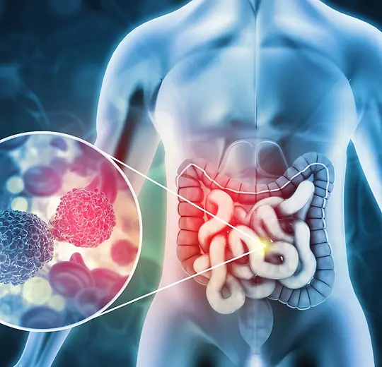 Colon cancer illustration.webp