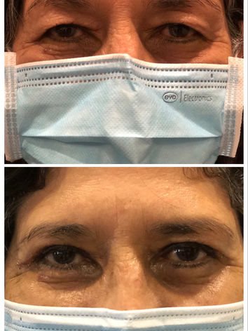 Before and 2 weeks after bilateral upper eyelid blepharoplasty surgery. 