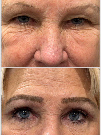 Before and 2 weeks after bilateral upper eyelid blepharoplasty surgery. 