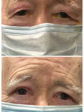 Before and 2 weeks after bilateral upper eyelid blepharoplasty surgery. 