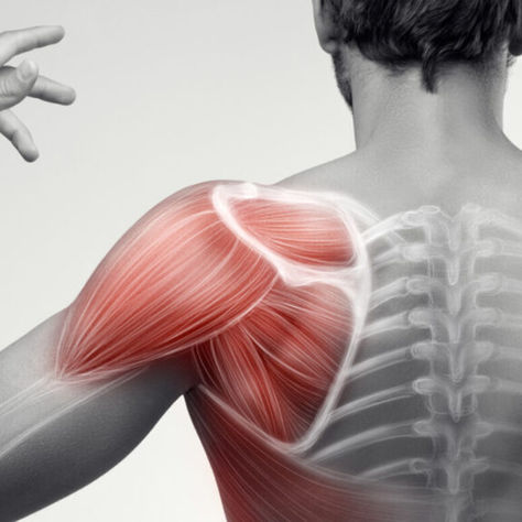 Schulterimpigement